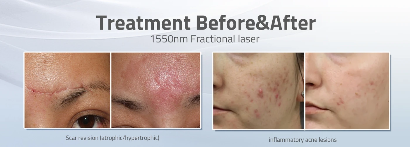 gentlefrax 1550nm fractional fiber laser machine