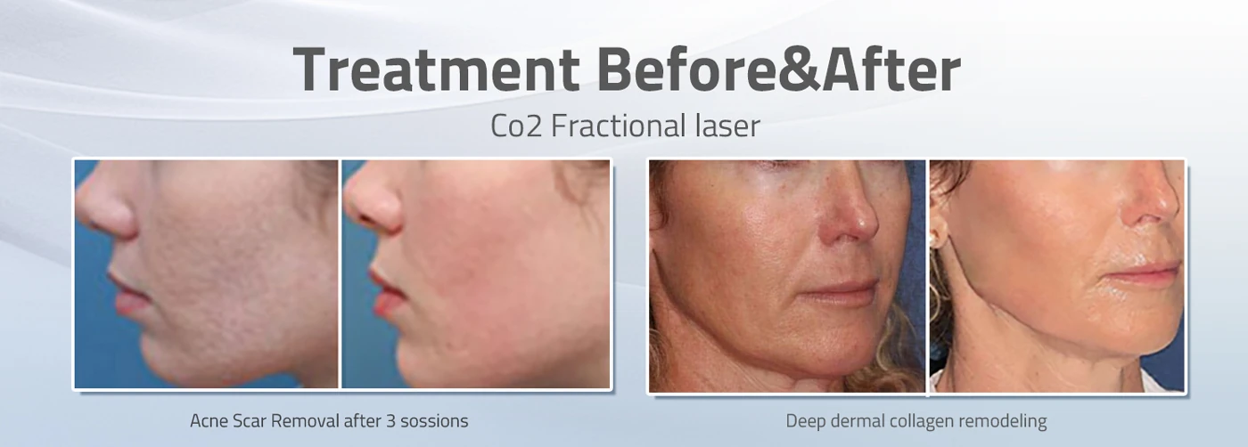 haifrax co2 fractional laser machine