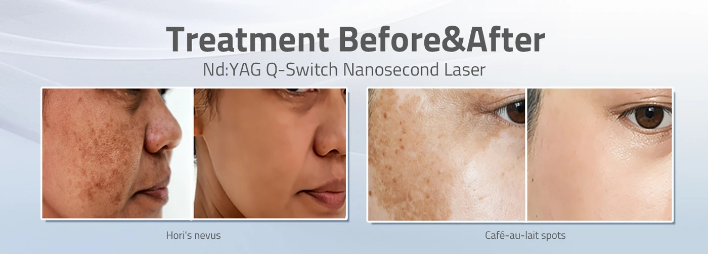 ultraq nd: yag q switch laser machine