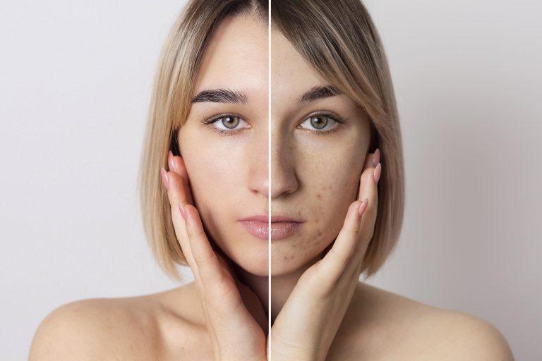 both gold microneedle and co2 fractional laser have certain efficacy in the treatment of facial acne atrophic scars