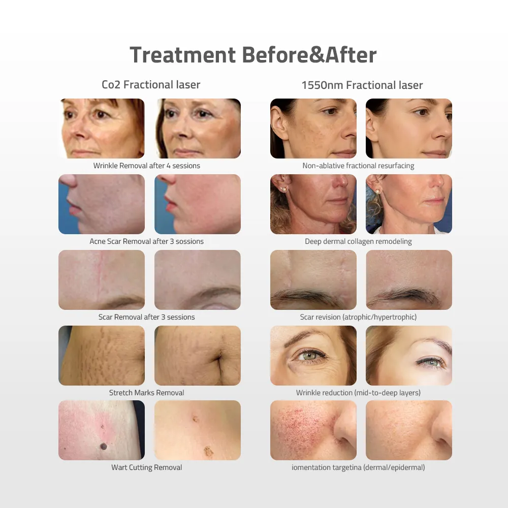 Haifrax CO2 FRACTIONAL LASER MACHINE