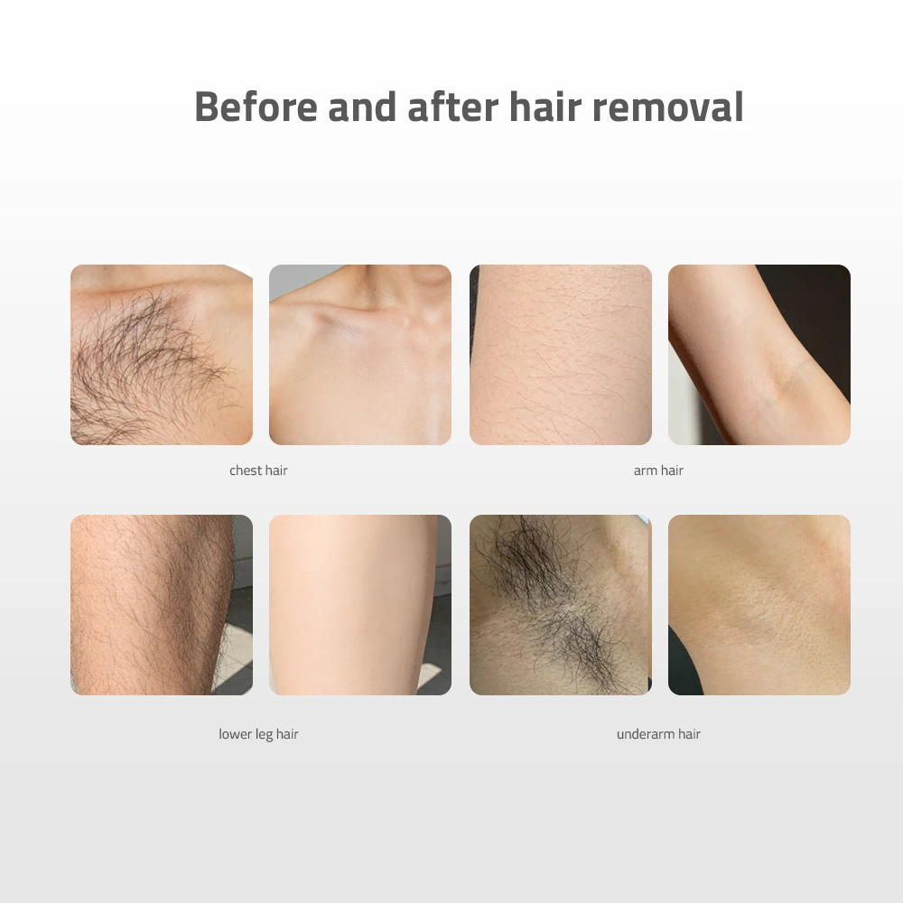LAMIS XL 808nm HAIR REMOVAL DIODE LASER