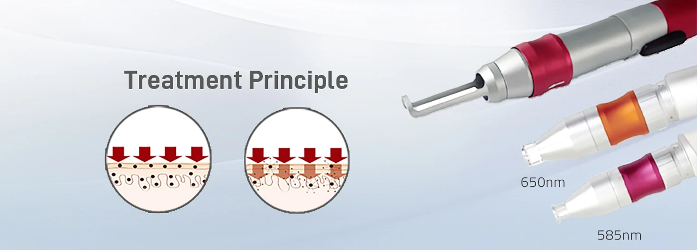 re bean q switched nd:yag laser