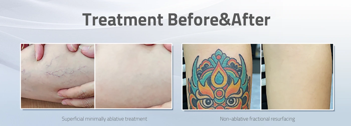 re bean q switched nd:yag laser