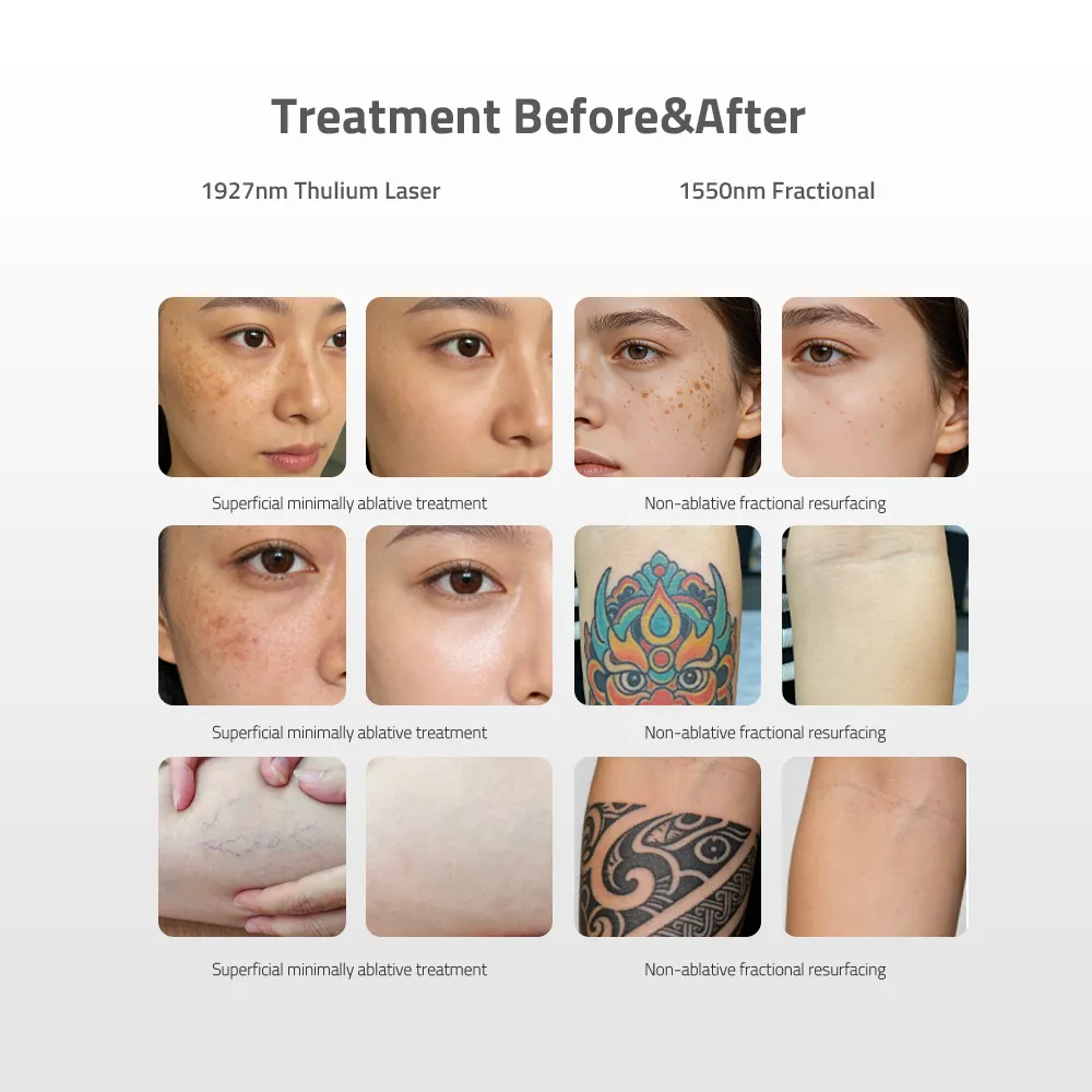 RE BEAN Q-SWITCHED ND:YAG LASER