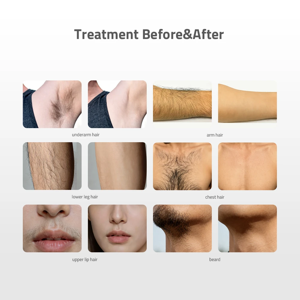 Stella PRO DIODE LASER HAIR REMOVAL MACHINE