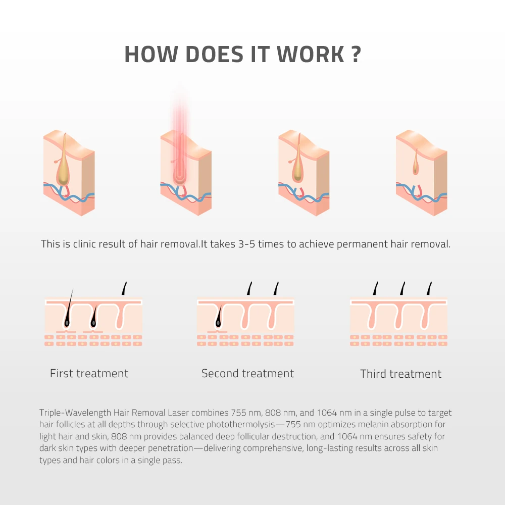 Stella PRO DIODE LASER HAIR REMOVAL MACHINE