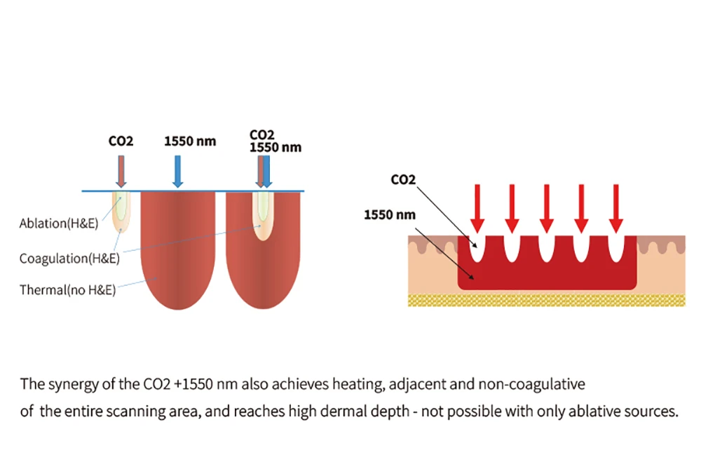 co2 laser fractional vs erbium glass laser depth