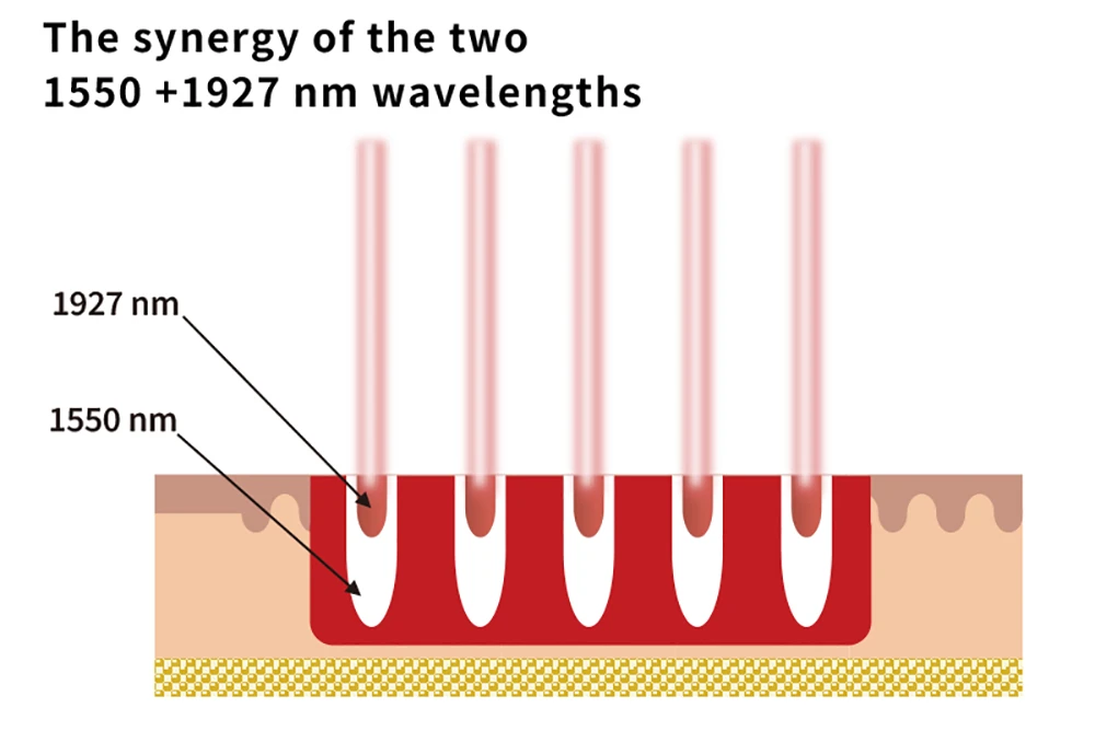 dual wavelength skin penetration thulium laser machine diagram