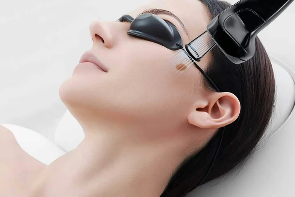 thulium laser machine facial pigmentation removal process