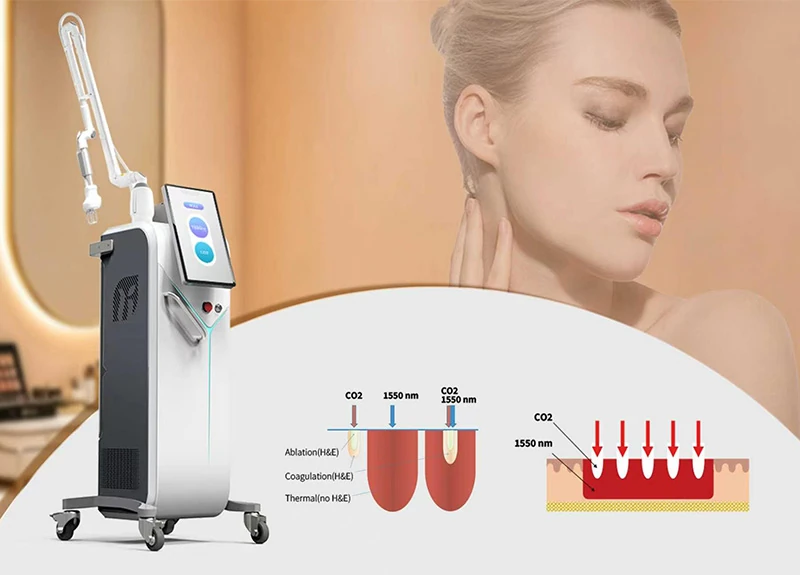 Unlock the Secret of Skin Resurfacing: Haifrax Pro 10600nm+1550nm