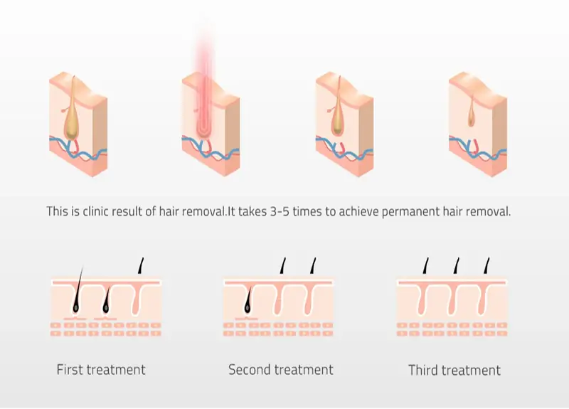 Maximizing MedSpa ROI: Why Triple Wavelength Diode Laser Hair Removal Machines Dominate the Market