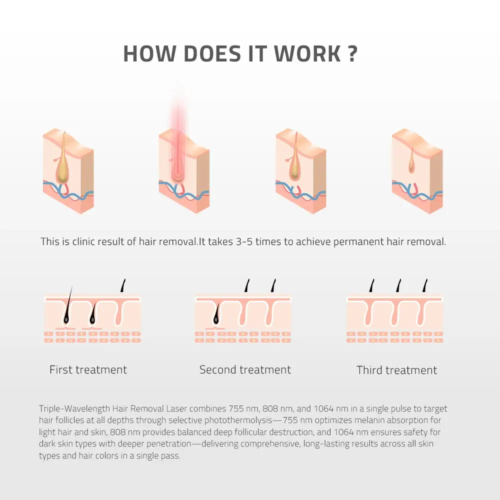 Triple wavelength diode laser hair removal treatment process showing how 755nm, 808nm, and 1064nm wavelengths target hair follicles at different depths