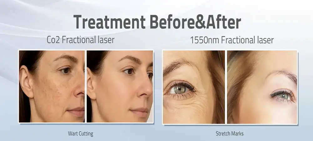 Haifrax Dual laser system featuring 1550nm Erbium Glass and CO2 fractional technology for professional skin rejuvenation clinics.